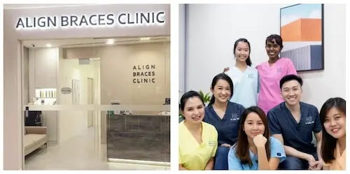  Align Braces - Braces Singapore