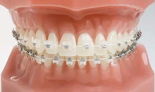 A Line Dental Braces Clinic - Ceramic Braces Singapore