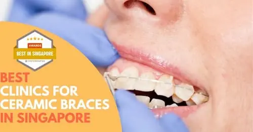 Best Ceramic Braces Singapore