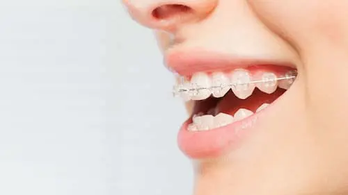  Raffles Dental - Ceramic Braces Singapore