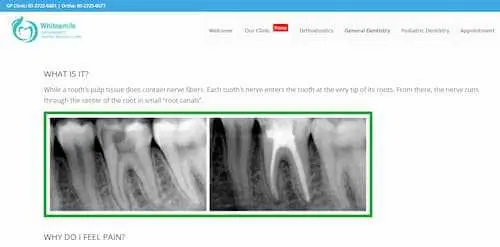 WhiteSmile Orthodontic Dental Braces Clinic - Root Canal Treatment KL Selangor